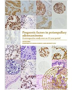 Prognostic factors in periampullary adenocarcinoma